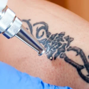 Tattoo Removal