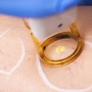 a woman getting a Microneedling treatment